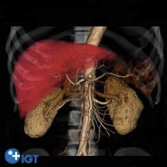 ゲートタワーＩＧＴクリニック　特殊がん検診　肺がんセットの特産品画像